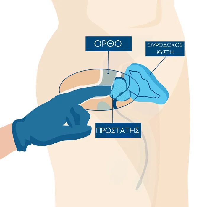 Σχεδιάγραμμα που δείχνει τη θέση του προστάτη, του ορθού και της ουροδόχου κύστης σε ανδρικό σώμα.